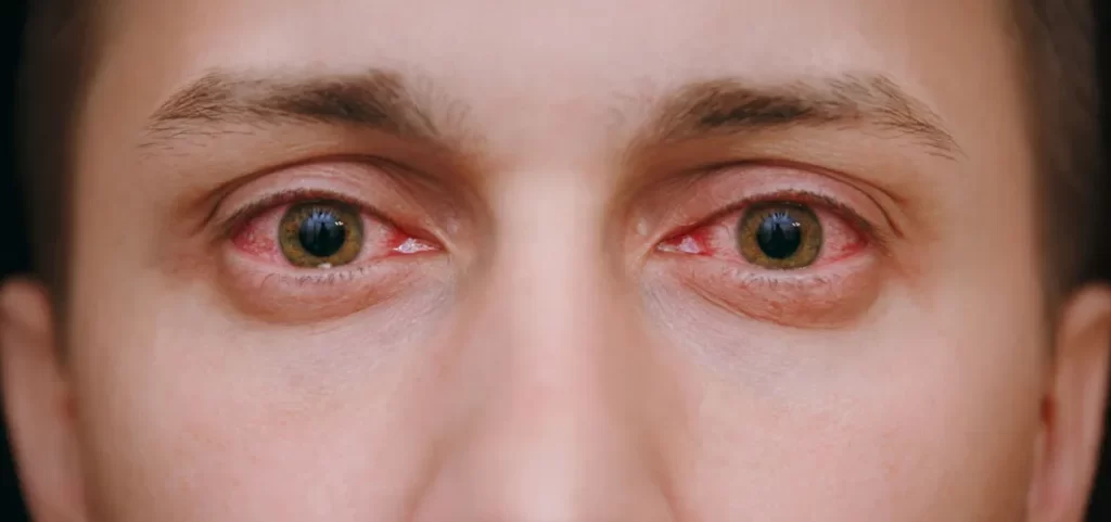 Eye Flu: आई फ्लू बना सकता है अंधा, ये लक्षण नजर आएं तो इलाज कराएं
