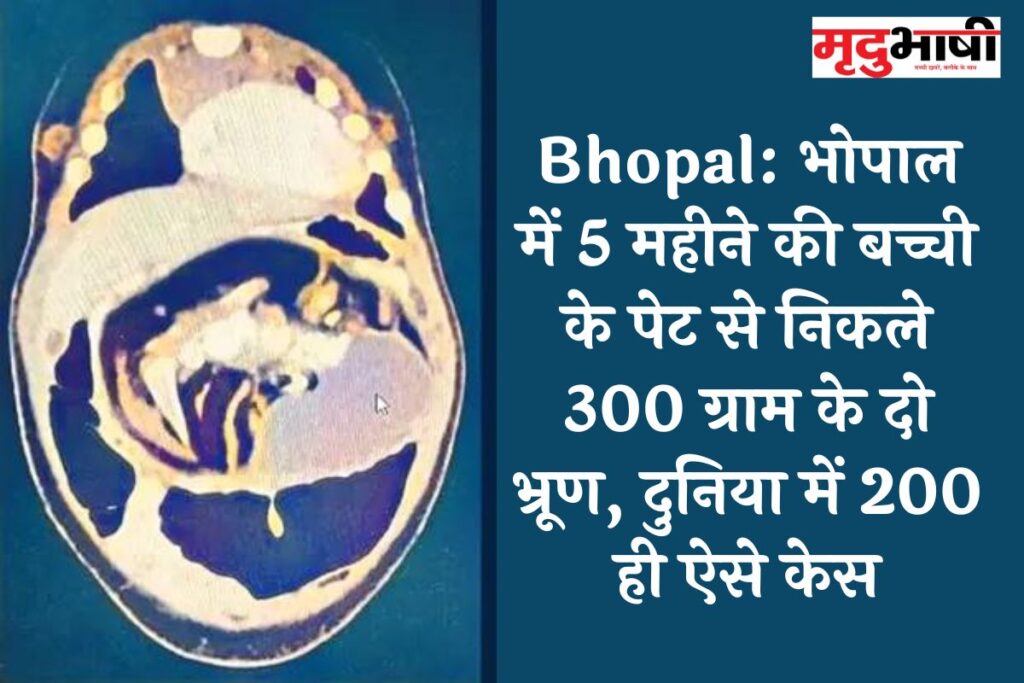 Bhopal: भोपाल में 5 महीने की बच्ची के पेट से निकले 300 ग्राम के दो भ्रूण, दुनिया में 200 ही ऐसे केस